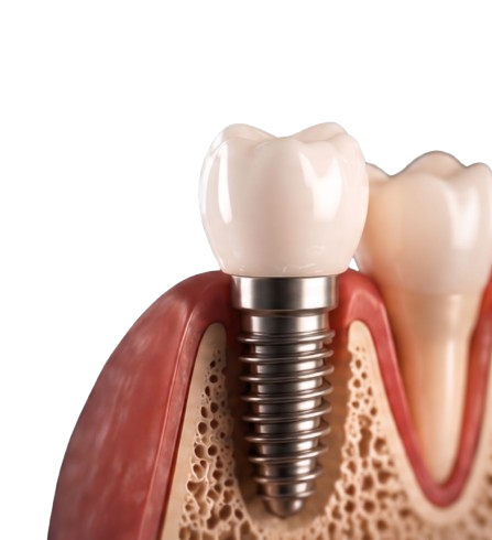 Implante Dentário
